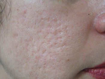 huidaandoening-littekens-acne